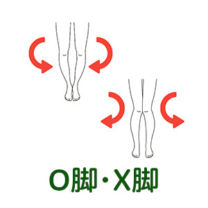 O脚・X脚